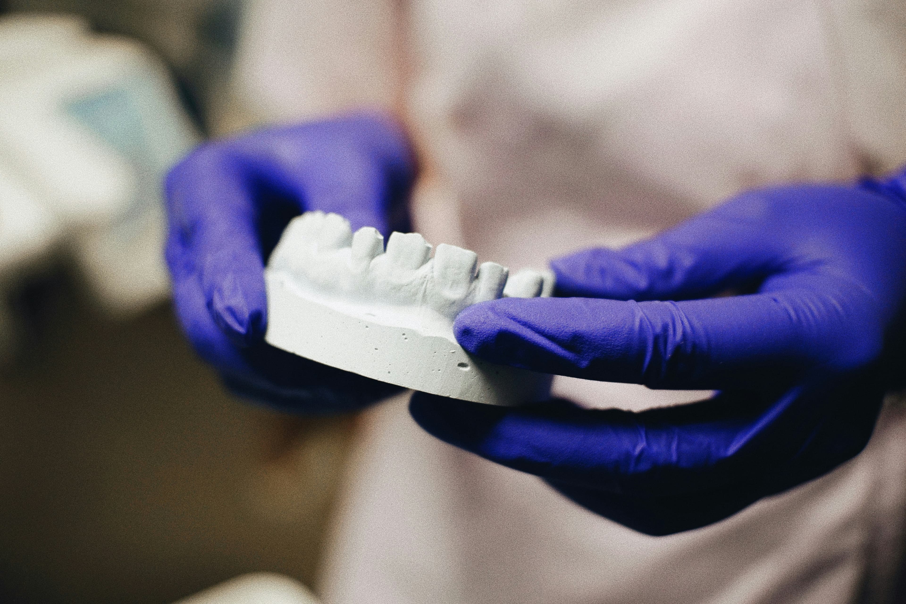 Hands in blue gloves holding a white plaster dental mold of a patient's teeth.