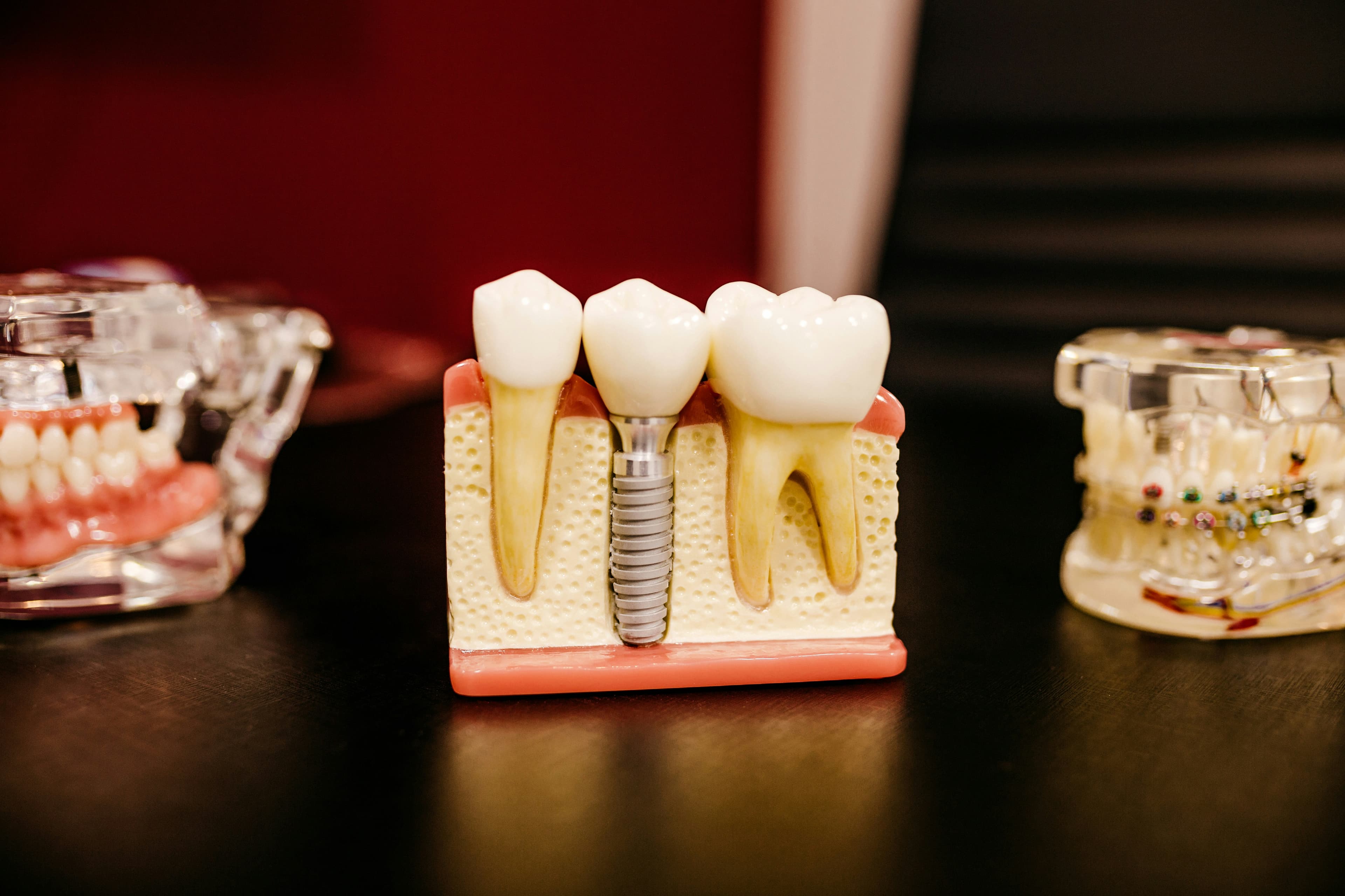 Dental model showing a tooth implant screw between two natural teeth with visible roots.